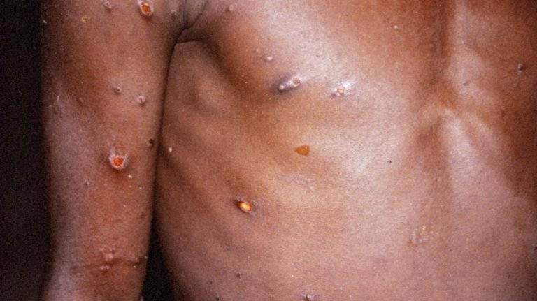 KISUMU COUNTY CONFIRMS FIRST CASE OF MPOX, ISSUES PUBLIC HEALTH ALERT